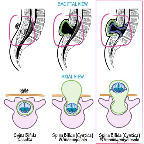 Neuroanatomy Glossary Spina Bifida With Meningomyelocele Ditki