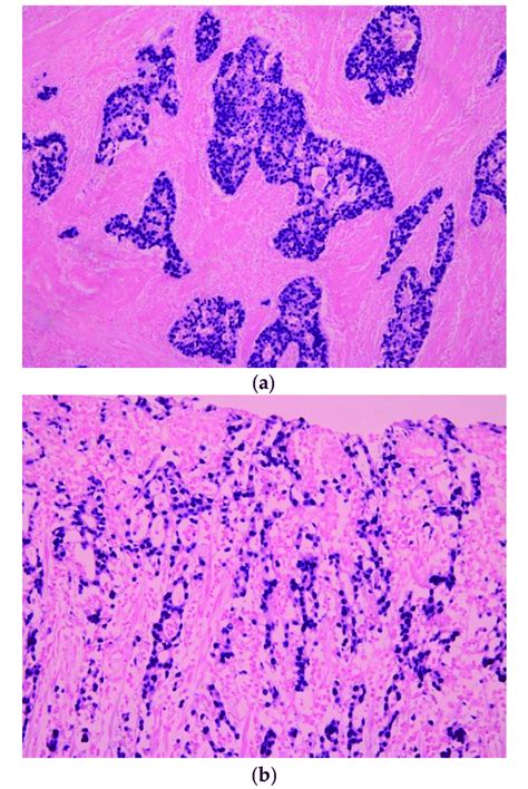 Histologic Characteristic Of Epstein Barr Virus Associated Gastric