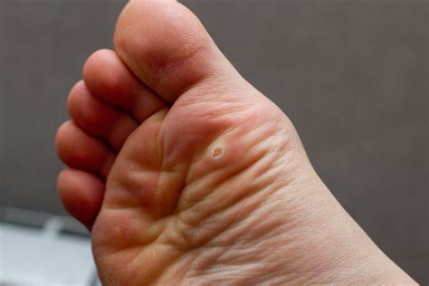 How To Treat Plantar Warts Heartland Foot And Ankle