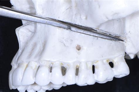 Twist Technique For Pterygomaxillary Dysjunction In Minimally