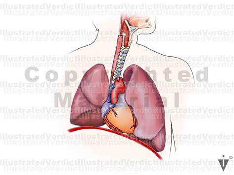 Case At A Glance Lung Cancer Right Upper Lobectomy Illustrated Verdict