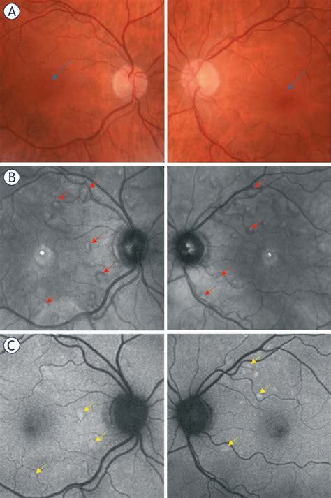 A Discrete Bilateral Lesions In The Fovea Seen On Fundus