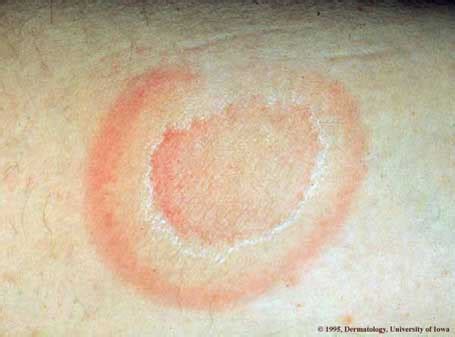 Erythema Annulare Centrifugum | Department of Dermatology