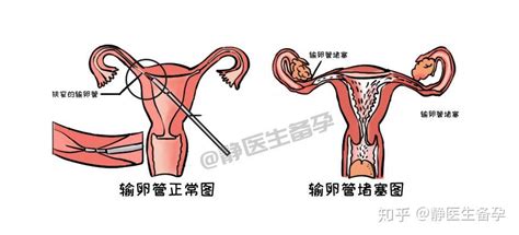 静医生不孕只要做输卵管造影就能怀上？真有这神奇的疗效？ 知乎