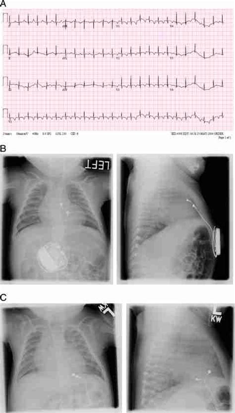 Ecg X Ray Neck Veins