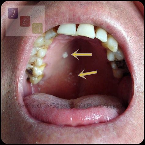 Oral Lichen Planus Cheek