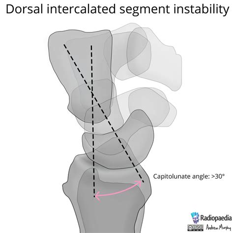 Filenormal Wrist Alignment Dorsal And Volar Intercalated Segmental