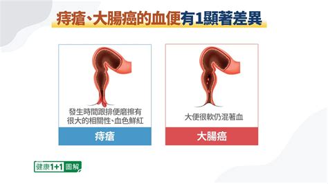 【健康11】便血是痔瘡還是大腸癌？醫師介紹四種大腸癌徵兆 癌症 膳食纖維 大紀元