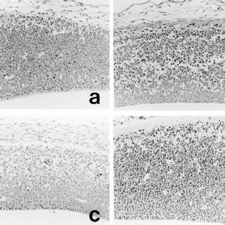 Electron micrograph of pyknotic cells in the fetal CNS. Condensation of ...