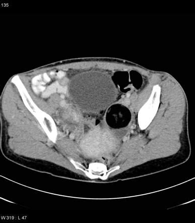 Mature Cystic Ovarian Teratoma Radiology Reference Article