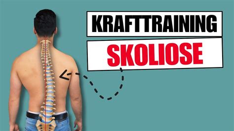 Krafttraining mit Skoliose Ist das gefährlich YouTube