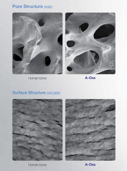 A Oss Xenograft Bone By Osstem Practical Implantology Shop