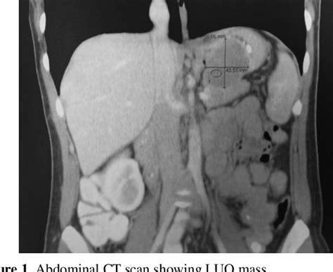 Figure From Gastric Schwannoma A Rare Schwann Cell Tumour Of The Gi