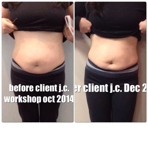 All New Before and After Pictures – Healing the Diastasis Recti 2015 ...