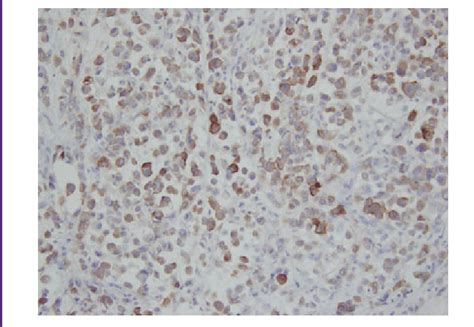 Ihc Staining Of Resected Ppsrcc Specimen Demonstrating Positive Muc