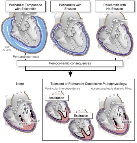 Constrictive Pericarditis