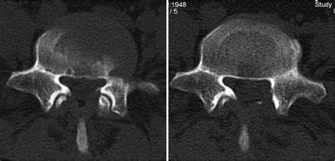 Lateral Recess Lumbar