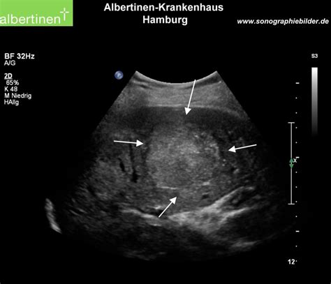 Hepatozelluläres Karzinom DocCheck Flexikon