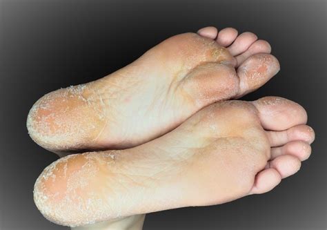 Peeling Feet Symptoms Causes And Treatment 58 Off