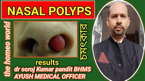 Nasal Polyps। Homeopathic Medicine Bangla। Homeopathic Treatment