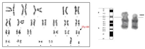 The Karyotype Showing Deletion Of The Short Arm Of Chromosome 18 Download Scientific Diagram