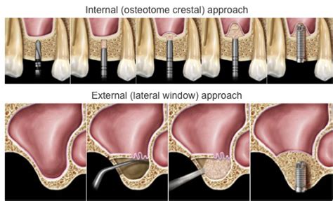 Sinus Lift Surgery, Complications & Recovery - Elite Dental Care Tracy ...