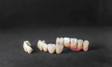 How Long Do Dental Crowns Last