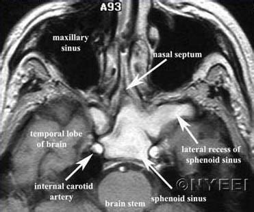 Sphenoidotomy Sinus Surgery - NYEE