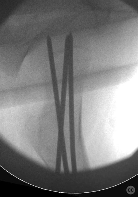 SCFE - longitudinal images over 6 years: 10-16years old