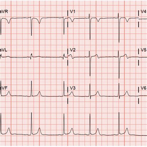 Baseline Ecg Demonstrating Pre‐excitation Consistent With Anteroseptal