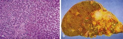 Malignant Tumors Of The Liver Radiology Key