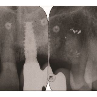 Standard Occlusal Radiograph Taken At Initial Consultation The