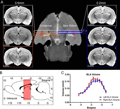 Hippocampus And Amygdala Mri