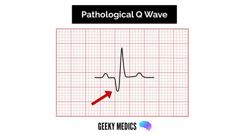 Pathological Q Waves Ecg / Cariology: W1D1AM at Wake Forest University ...