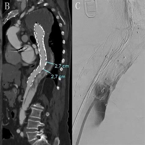 Multiplanar Reconstruction Of Ct Scan Showing The Measurement Of The Download Scientific