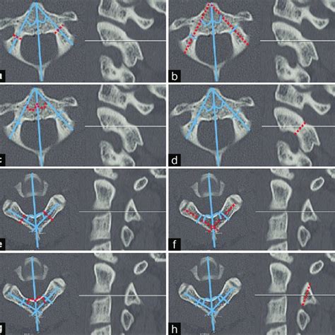 Measurement Techniques Of The Axis A Pedicle Width Dashed Line