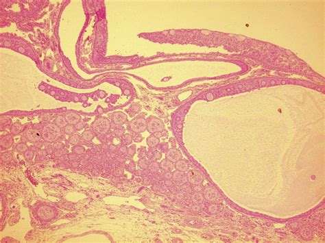 Juvenile Granulosa And Theca Cell Tumor Of The Ovary As A Rare Cause Of