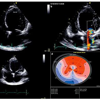 A Transthoracic Echocardiogram Apical Chamber View Showing Severe