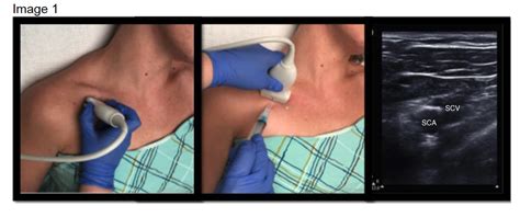 Guide To Ultrasound Subclavian Lines USF Emergency Medicine