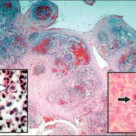 Skin Biopsy Specimen Showing Epidermal Hyperplasia Intraepidermal