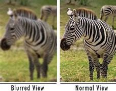 amblyopia american association  pediatric ophthalmology  strabismus