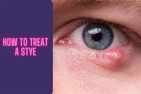 How To Treat A Stye Home Remedies And Tips For Relief