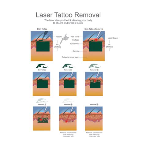 San Diego CA Laser Tattoo Removal | La Jolla Professional Tattoo