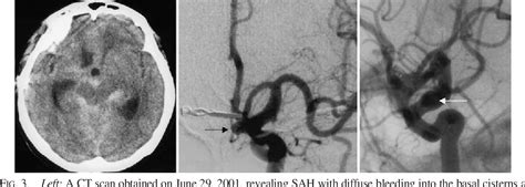 Structure Of Superior Hypophyseal Artery Semantic Scholar