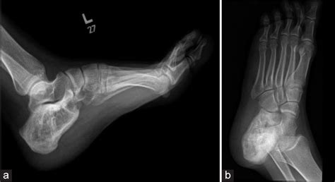 Calcanectomy in primary high-grade sarcomas: Foot salvage without the need for any ...