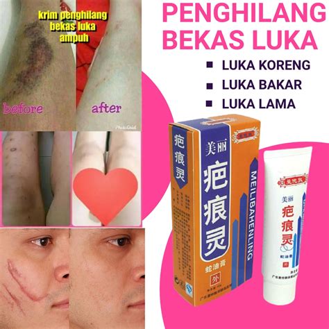 Jual Obat Penghilang Bekas Luka Menghilangkan Bekas Luka Lama Hitam