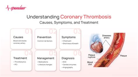 Decoding Coronary Thrombosis: Causes, Symptoms, & Treatment