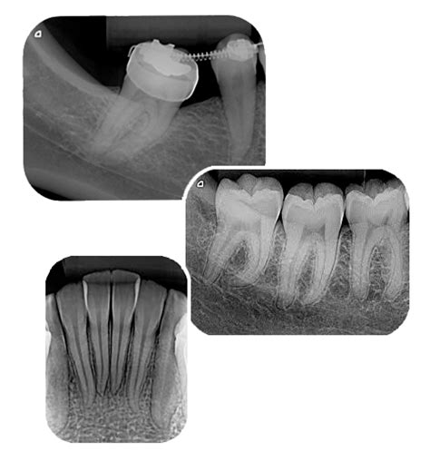 Quanto Custa A Radiografia Periapical Completo Guia De Pre Os