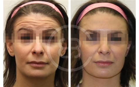 Botox En Barcelona Girona Y Mallorca Clínica Bless