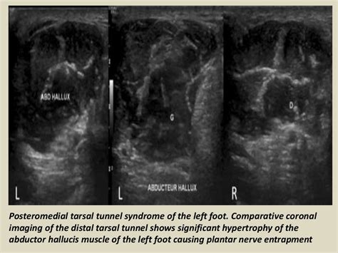 Presentation1 Radiological Imaging Of Tarsal Tunnel Syndrome